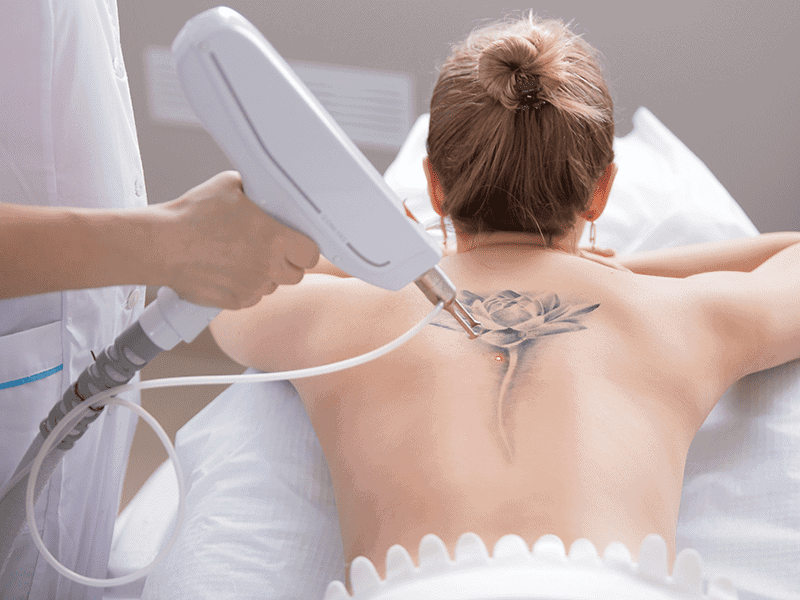 Personalized Tattoo Fading Treatments