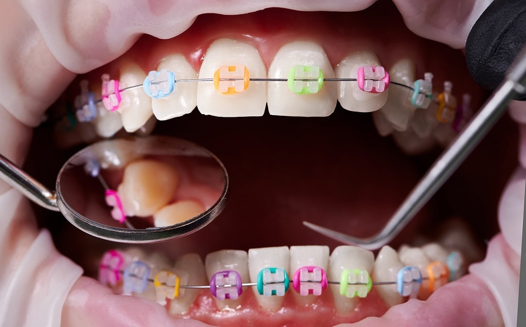 How Long Does Invisalign Take
